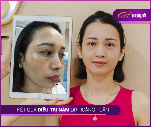 Kết quả điều trị nám tại Thẩm mỹ Hoàng Tuấn